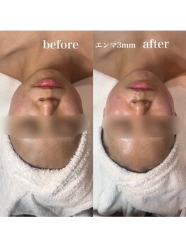 テンディ(TenD.)/エクラエンマトリートメント