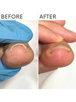 クオッカ(Quokka)/巻き爪ケア