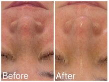 サロンドフェイス(Salon de Faith)/フォト+ハーブピーリング3回