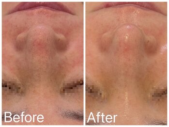 サロンドフェイス(Salon de Faith)/フォト+ハーブピーリング3回