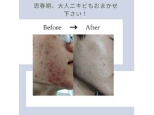 【メンズ脱毛】Beauty salon Lovina【ロビナ】長野駅前店の雰囲気（肌荒れ・シミ・ニキビも綺麗に！）