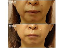 ニカ(NIKA)の雰囲気（光フェイシャル＋糸リフトでたるみと透明感UP！若々しいハリつや）