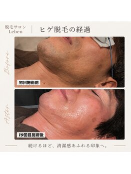 レーベン 戸畑店(Leben)/ヒゲ脱毛変化