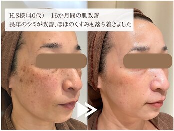 レイテノール 藤沢店/全国入賞したシミ改善症例！