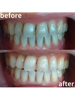 ココホワイトニング(coco whitening)/シルバーコース8分照射×2回