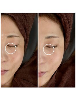 カラット(CARAT)/光フェイシャル/小顔/艶肌/美肌