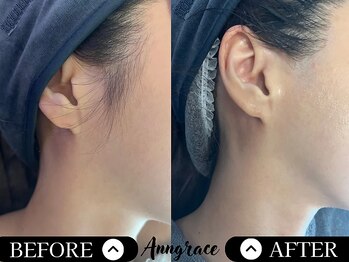 アングレイス(Anngrace)/【全身脱毛お顔】Before/After