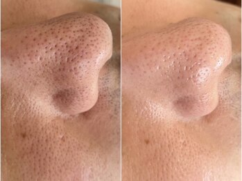 ベルエクラ(Bel Eclat)/毛穴ケアBefore After/那覇