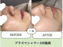 ベネミー 恵比寿(Benemi)/プラズマシャワー