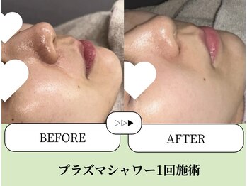 ベネミー 恵比寿(Benemi)/プラズマシャワー