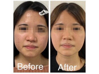 Beauty salon Ren/ハーブピーリング