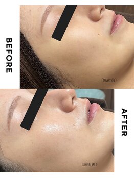 ホソナル(HOSONAL)/セラピール