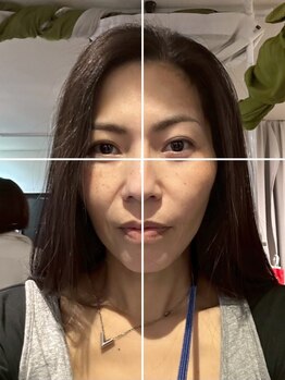 リフュージュ 隠れ家の写真/オールハンドの切らない小顔リフト!半顔施術後に鏡で確認し感動♪フェイスラインが引き上がり目もパッチリ