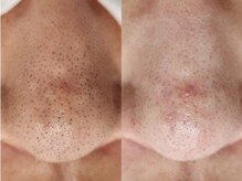 脱毛サロン ベル(Bell)/ハイドロ毛穴洗浄導入！