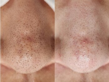 脱毛サロン ベル(Bell)/ハイドロ毛穴洗浄導入！