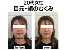 シン(SHINE)/美容鍼灸