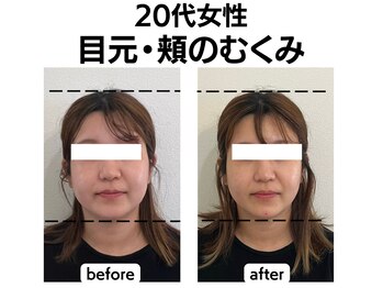 シン(SHINE)/美容鍼灸