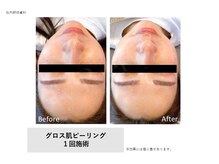 トータルクリア(TOTAL CLEAR)/Gloss肌ピーリング