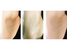 フィッツワン(フィッツONE)/わき脱毛♪