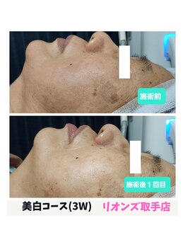 リオンズ 茨城ミスターマックス取手店/くすみ肌から卒業【美白コース】