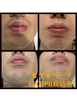 リアンジュ/髭脱毛の経過