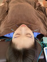 ハリファ鍼灸院 横浜関内院(HariFa鍼灸院)/美容鍼施術/美容鍼