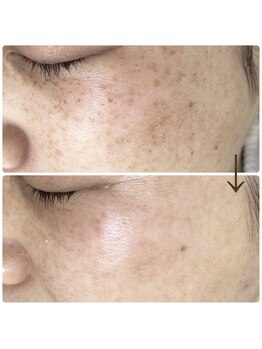 スーン(soon)/シミケアと美白を同時に！