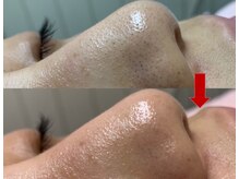 ブリリアン デイスパ 阪急西宮ガーデンズ店(BRILLIAN DAYSPA)/毛穴洗浄フェイシャル