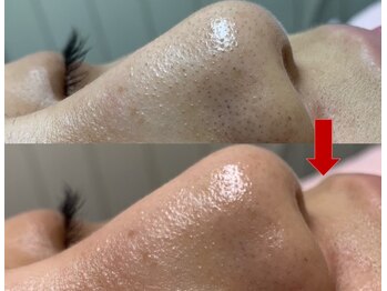 ブリリアン デイスパ 阪急西宮ガーデンズ店(BRILLIAN DAYSPA)/毛穴洗浄フェイシャル