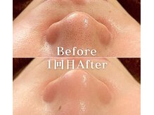 ミニョスキンラボ/毛穴撲滅パッケージ1回