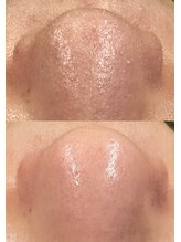 ハローハローアイラッシュ(Hello.Hello.eyelash)&nbsp;韓国式３D 毛穴洗浄