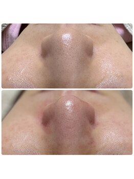 サラン(SALON)/鼻 ビフォーアフター