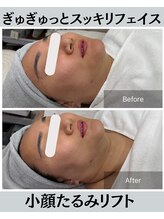 セレア(CELEA)/当店人気NO１/小顔リフトアップ