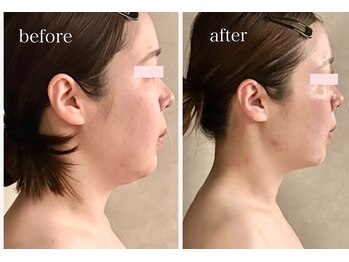 プレジール(Plaisir)/レモンボトル近赤導入＆サーマ