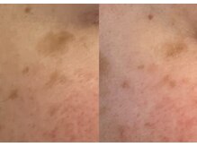 モガナ(mogana)/30代・小さい/大きいシミケア