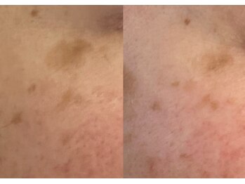 モガナ(mogana)/30代・小さい/大きいシミケア