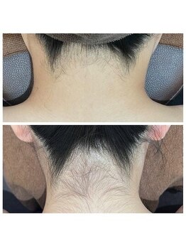 ミース 北九州店/うなじ△ビフォーアフター