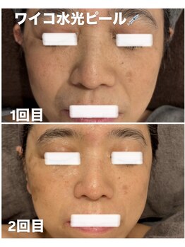 グレース(GRACE)/ワイコ水光ピール