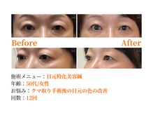 シルエラバレ(CiruelaValle)/Before After