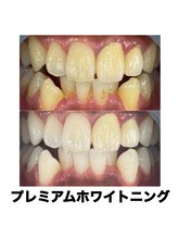 ホワイトニングカフェ 名古屋栄店(WhiteningCafe)/プレミアムホワイトニング♪