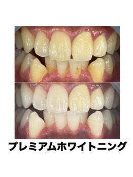 ホワイトニングカフェ 名古屋栄店(WhiteningCafe)/プレミアムホワイトニング♪