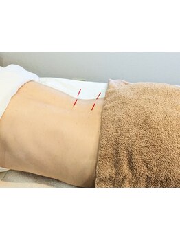 鍼灸施術を受けたい