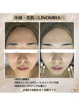 リノミラ(LINOMIRA)/小顔！肌強化！毛穴レス！
