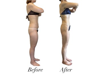 リノア(Lino'aka)/産後　○○さんの変化　痩ボディ