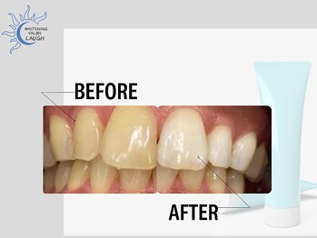 ラフ(LAUGH)/サロン用ジェルホワイトニング