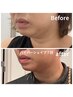 小顔フェイシャル60分【気になるお肉を解消】ほうれい線・ポニョにも