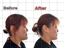 リビット 等々力(Rebit)/BeforeAfter,小顔調整