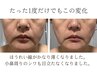 結果出し最高峰★エクソソーム×幹細胞培養液導入◎シミ/しわ/たるみ◎¥7800