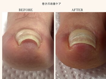巻き爪改善ケア