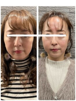 長寿鍼灸院 長寿整骨院/ハリネズミ女優美容鍼効果★